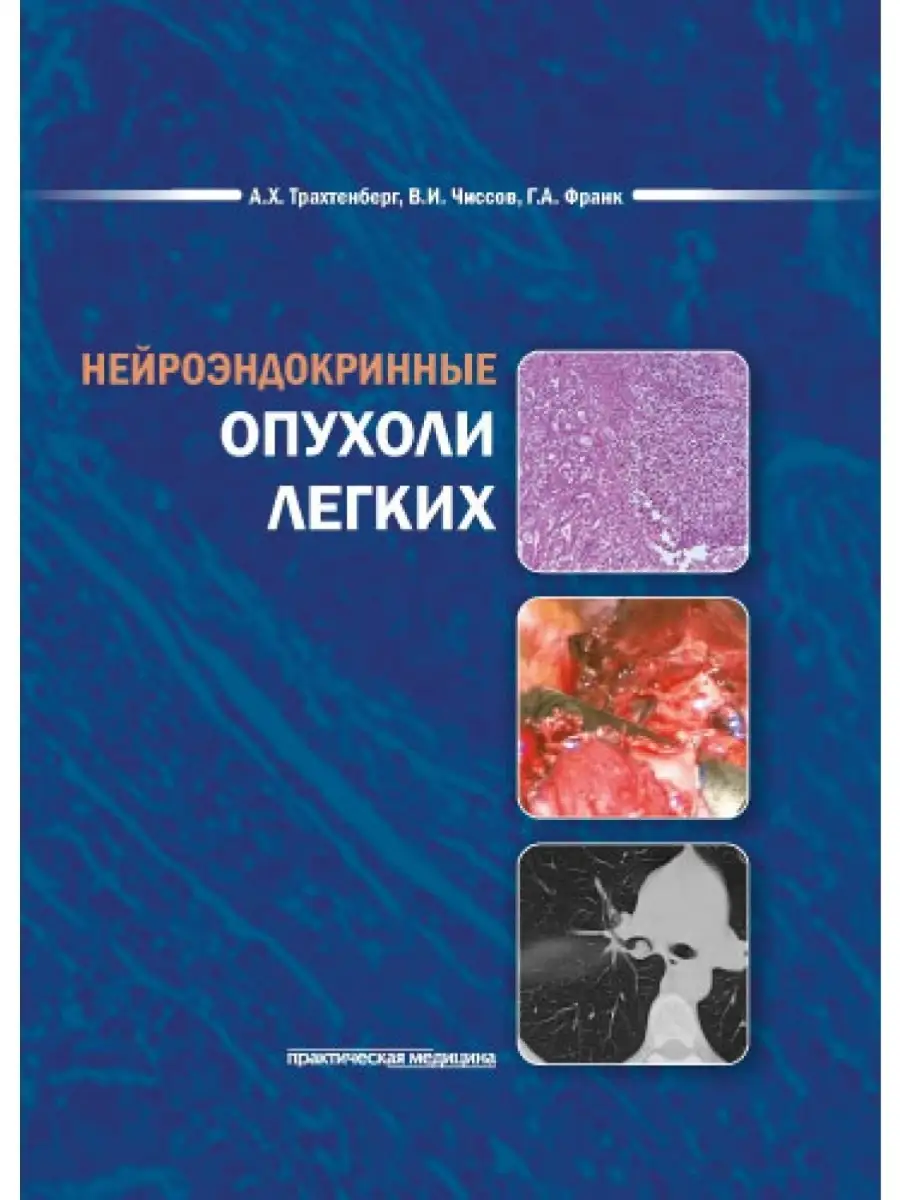 Нейроэндокринные опухоли легких Практическая медицина купить по цене 908 ₽  в интернет-магазине Wildberries | 80781324